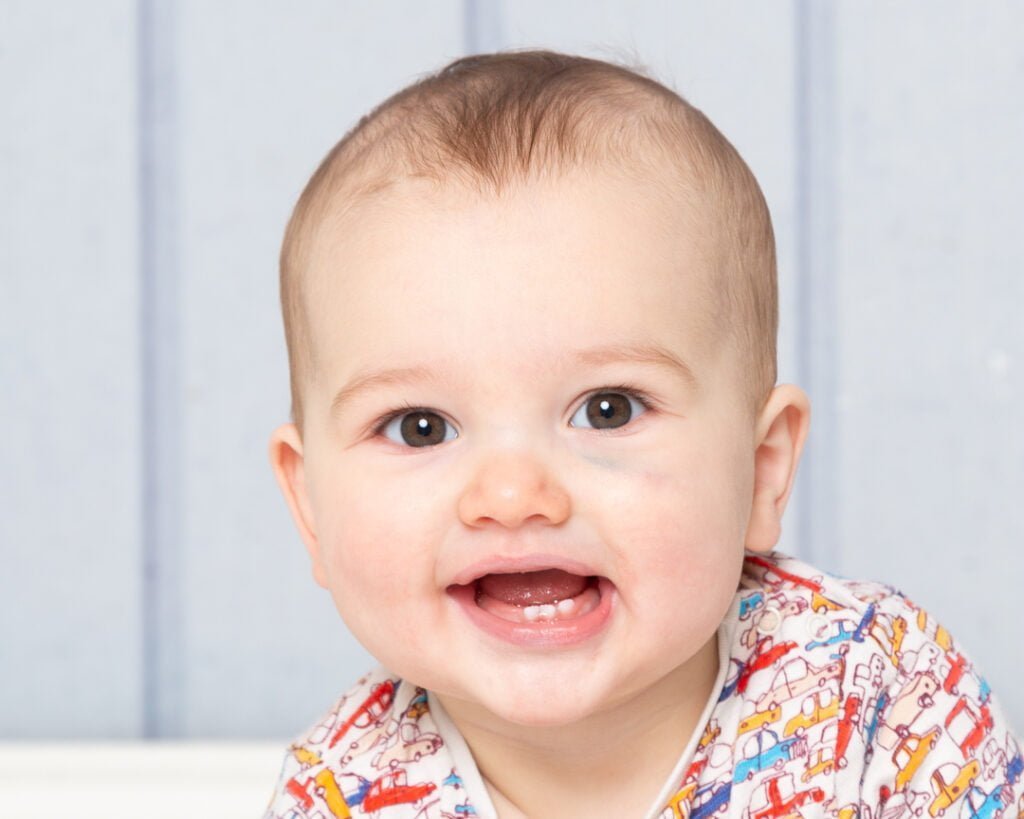 a little boy with a black eye at a photo shoot
